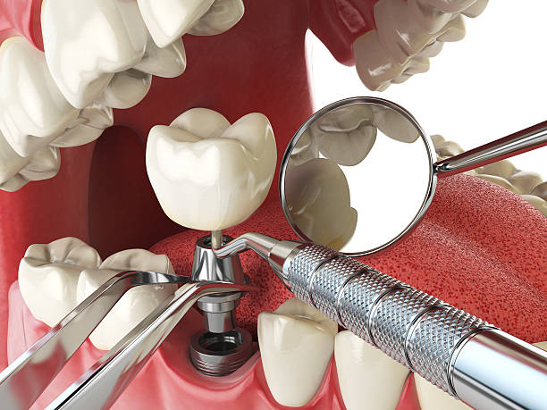 Best Emergency Root Canal Treatment in Asotin, WA